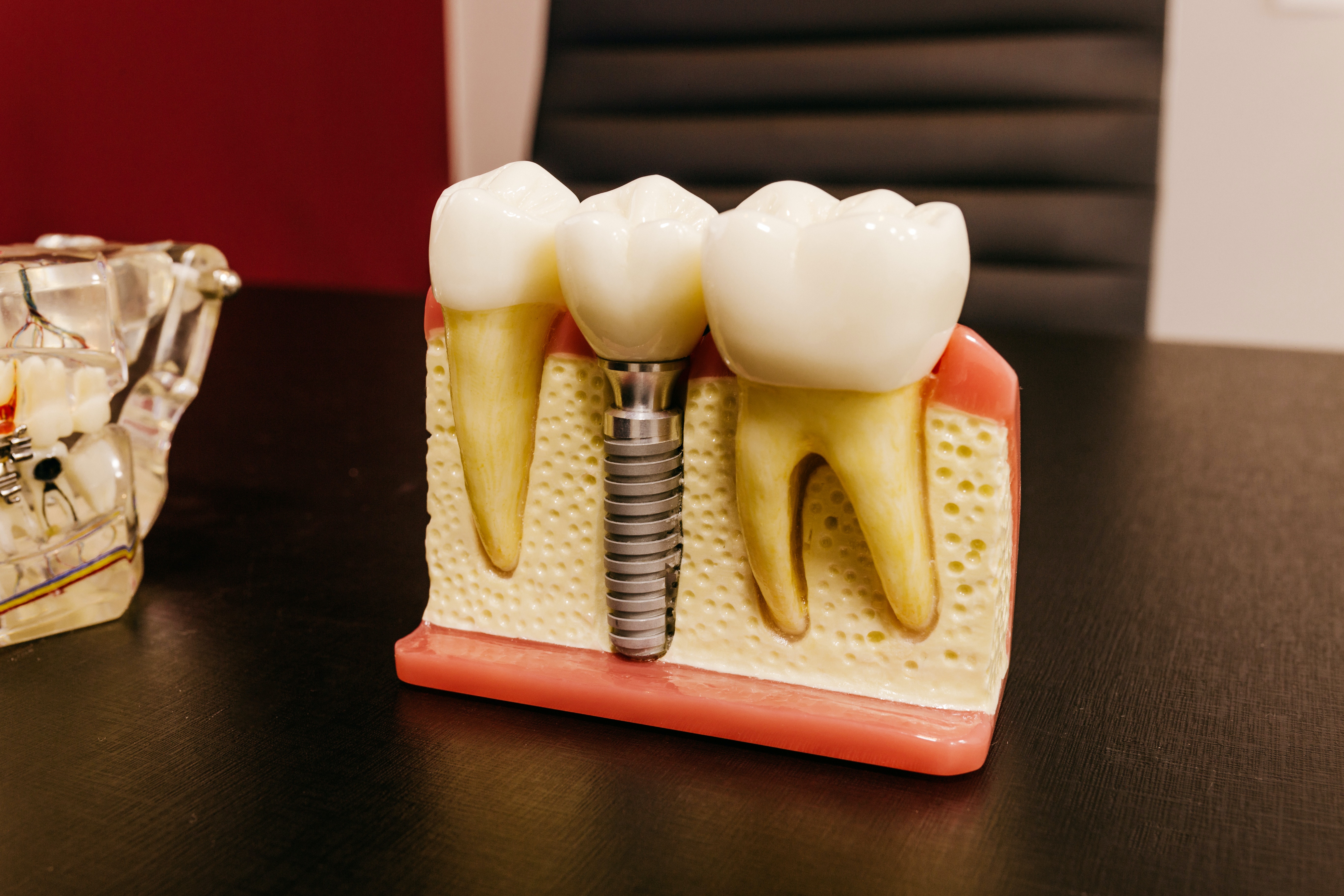 Dental Implants Dental Implants